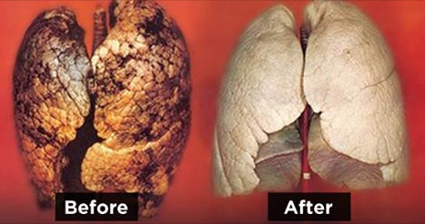 Duhanxhinj, ja si pastrohet mushkria nga toksina brenda 72 orësh!