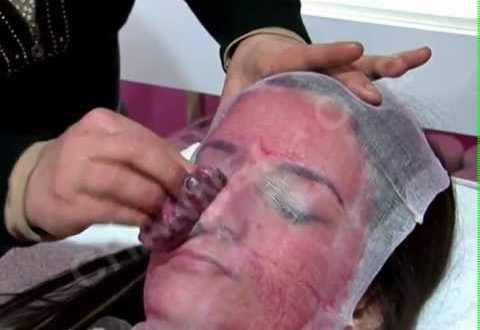 Mjekët kishin humbur grafin origjinal: Burri qëndroi një muaj e gjysmë pa fytyrë Mjekët kishin humbur grafin origjinal: Burri qëndroi një muaj e gjysmë pa fytyrë