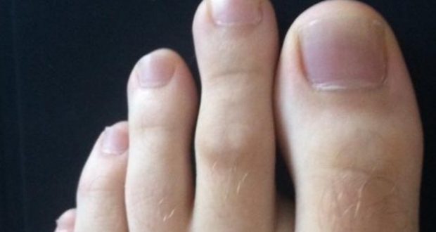 E keni gishtin e dytë të këmbës më të gjatë se të parin?! Ju jeni thjeshtë…! E keni gishtin e dytë të këmbës më të gjatë se të parin?! Ju jeni thjeshtë…!