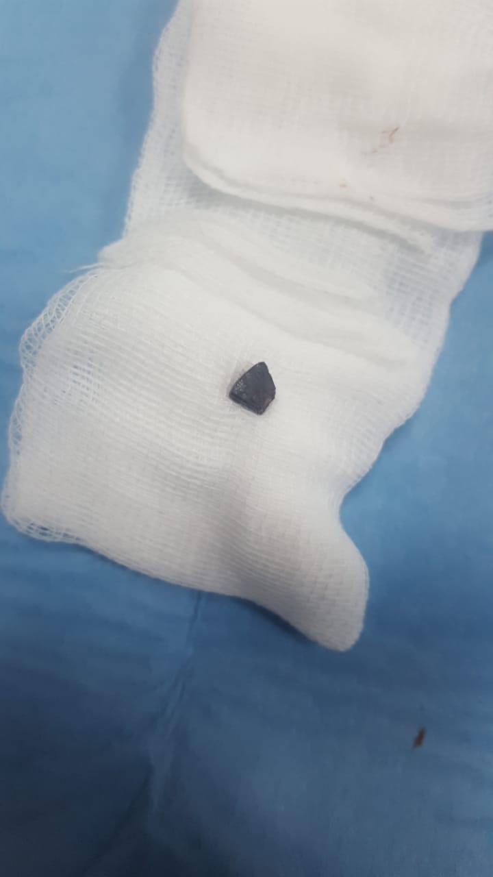 FOTOT/ Faktet që nxjerrin blof Bashën: Protestuesi u p.lagos me fishekzjarr (janë lënduar mes njëri tjetrit)