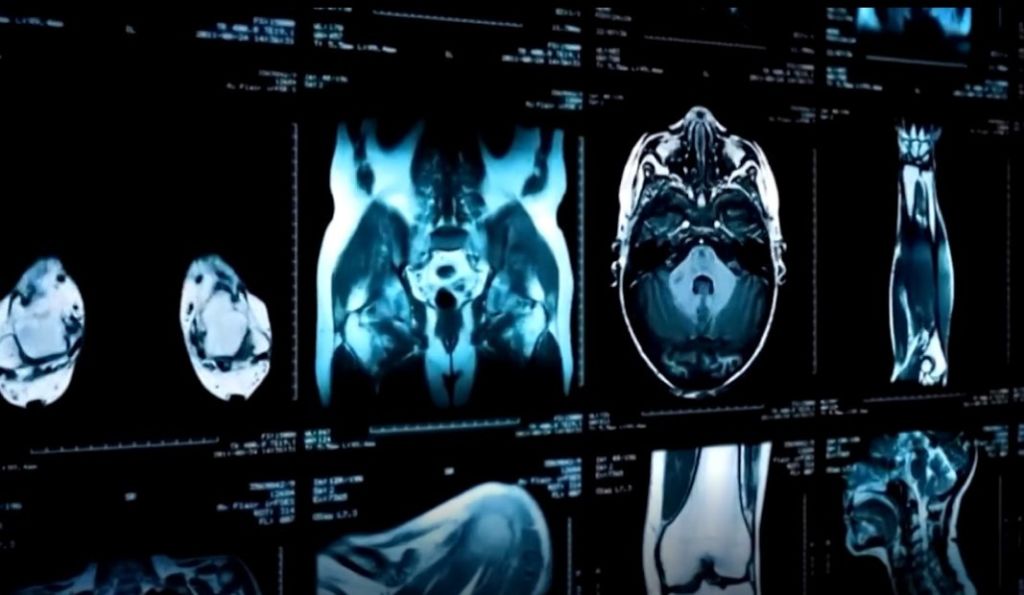 Kanceri, ndër “vrasësit” kryesor të shqiptarëve Kanceri, ndër “vrasësit” kryesor të shqiptarëve