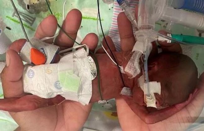 Mbijeton foshnja më e vogël në botë, lindi 132 ditë para datës normale Mbijeton foshnja më e vogël në botë, lindi 132 ditë para datës normale