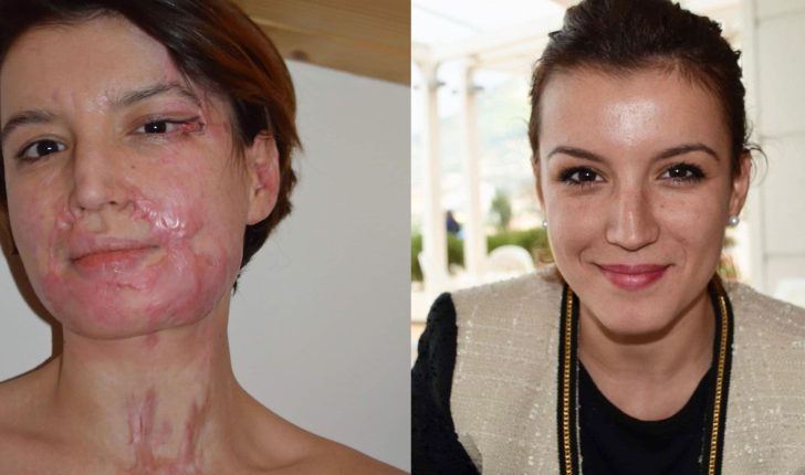 E sulmuan me acid në fytyrë në mes të Tiranës, Dule: Rindërtova fytyrën time, jetën time dhe qepja shpirtin tim si një enigmë E sulmuan me acid në fytyrë në mes të Tiranës, Dule: Rindërtova fytyrën time, jetën time dhe qepja shpirtin tim si një enigmë