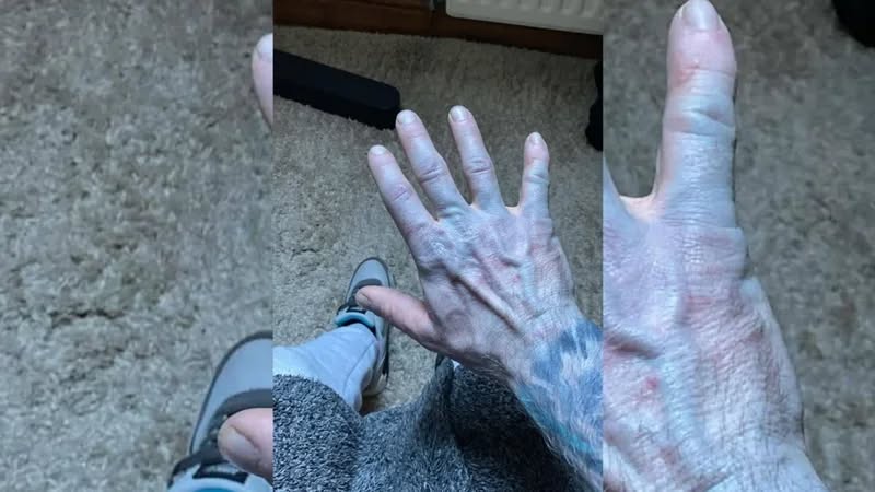 42-vjeçari zgjohet “si Avatar” dhe përfundon në spital! Çudia… kur zbulohet shkaku