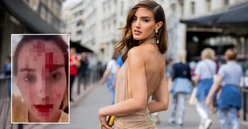 Skandal në Kanë! Miss Venezuela publikon videon tronditëse me fytyrën e mbuluar në gjak, akuzon stilistin e njohur për dhunë Skandal në Kanë! Miss Venezuela publikon videon tronditëse me fytyrën e mbuluar në gjak, akuzon stilistin e njohur për dhunë