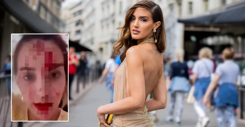 Skandal në Kanë! Miss Venezuela publikon videon tronditëse me fytyrën e mbuluar në gjak, akuzon stilistin e njohur për dhunë